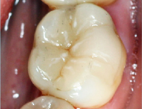 インレー施術後