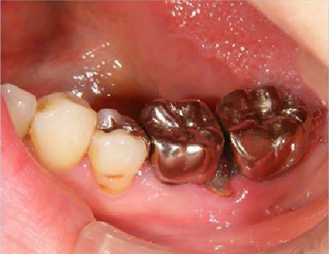 ルコニアインレー・クラウン（臼歯）施術前