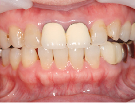 ジルコニアクラウン（前歯）施術前