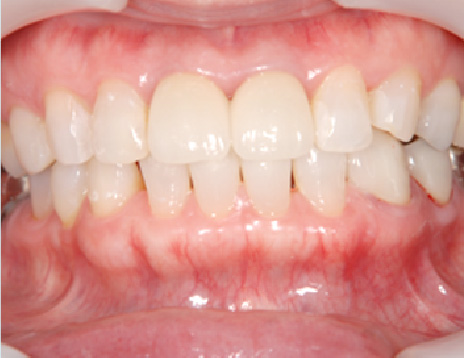 ジルコニアクラウン（前歯）施術後