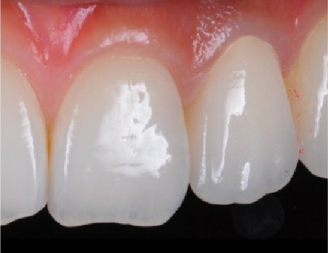 ジルコニアクラウン（前歯）施術後